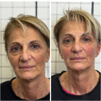 Sculptural Face Lifting & Bruxismo