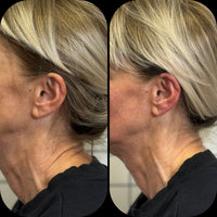 Sculptural Face Lifting & Bruxismo