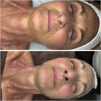 Sculptural Face Lifting & Bruxismo